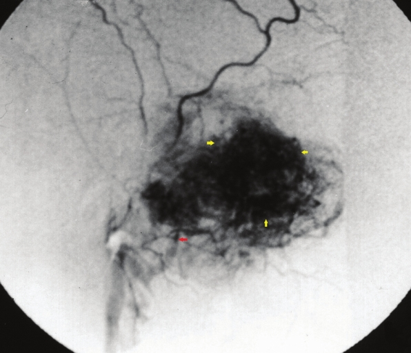Right external carotid artery angiogram reveals the feeding internal maxillary artery (red arrow) and the hypervascular lesion (yellow arrows).
